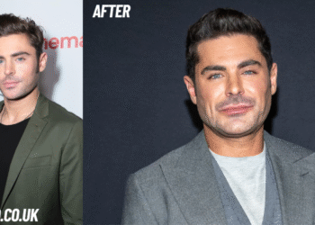 zac efron face accident