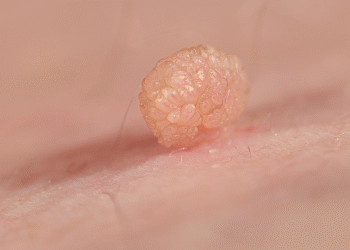 Is That a Tag or Something Else? Why a Doctor Must Check Before Removal